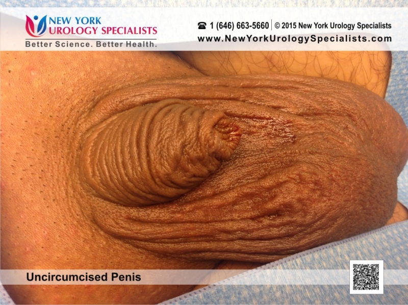 azam aris recommends uncircumcised penis image pic