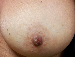 Abnormal Nipples Pics leaked sexy
