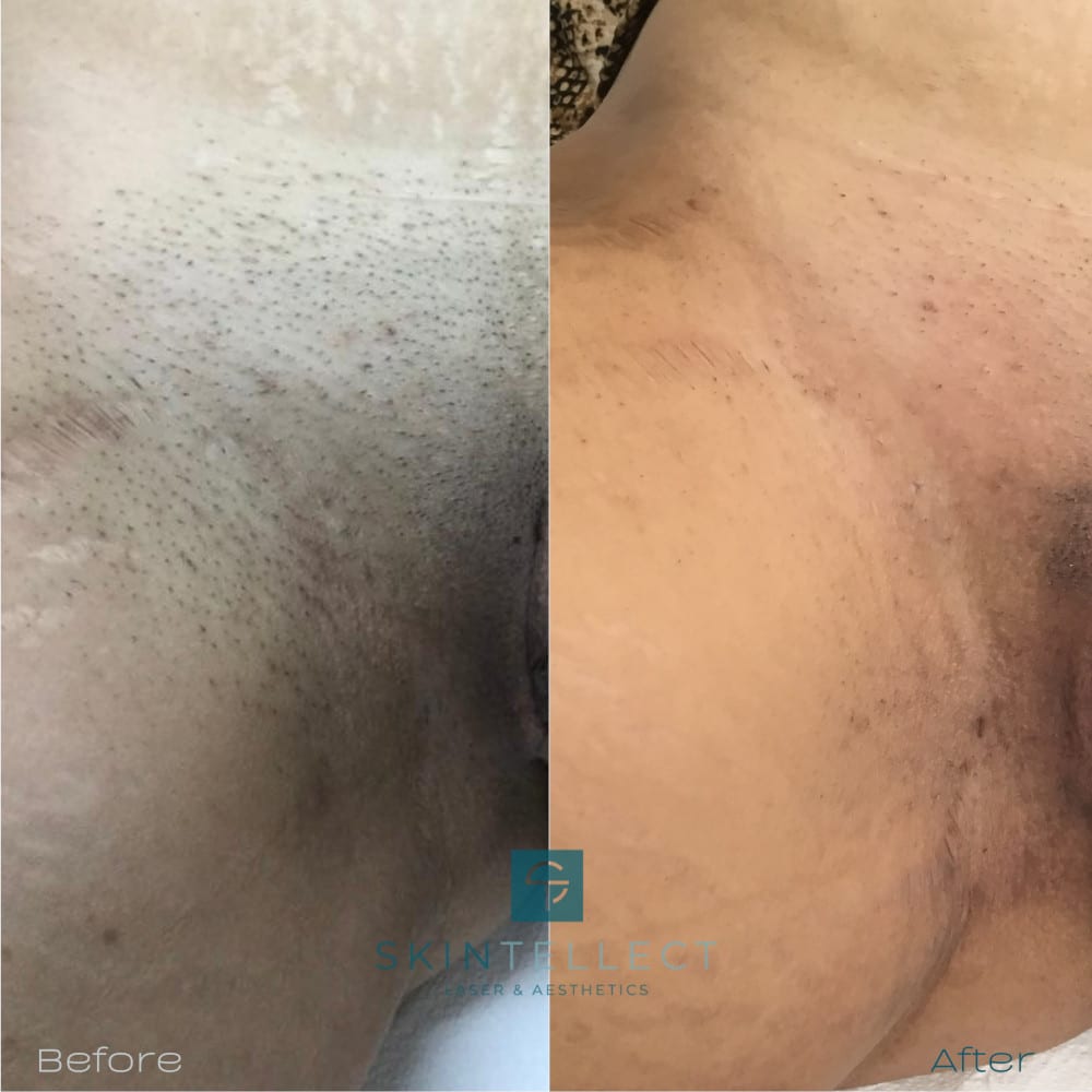 abou alaa recommends Anal Bleaching Before And After Pics