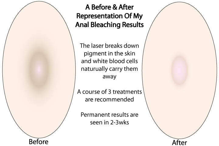 christina hack recommends Anal Bleaching Before And After Pics