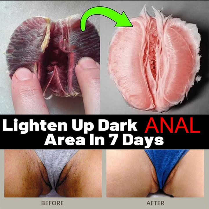 carlos puigdollers share anal bleaching before and after pics photos