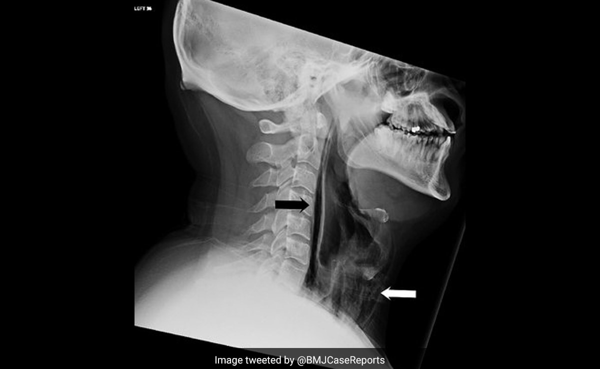 chelsea toler recommends xray of deep throat pic