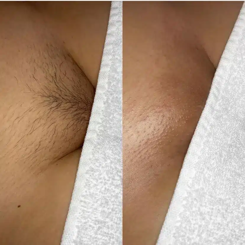 alvin diamante recommends brazilian wax real pictures pic