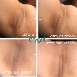 Anal Bleaching Before And After Pics star candy