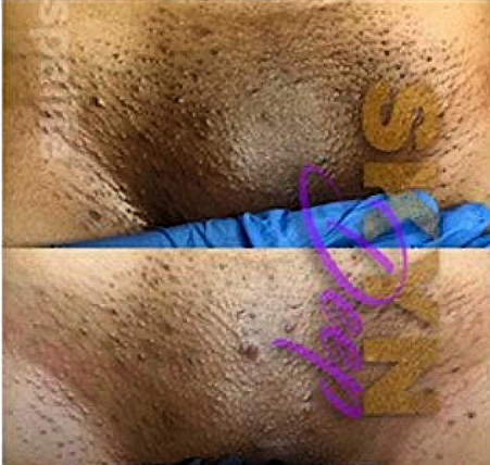 coral barnes recommends anal bleaching before and after pics pic