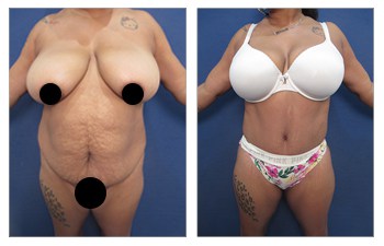 Bbw With Breast Implants uppsala analplugg