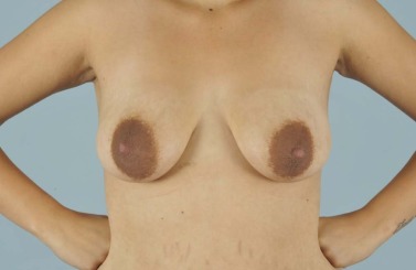 betty bales recommends Breasts With Large Nipples